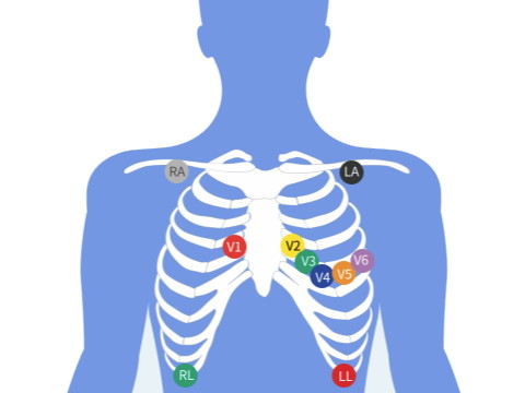 康复阶段为什么要进行心脏康复监测？