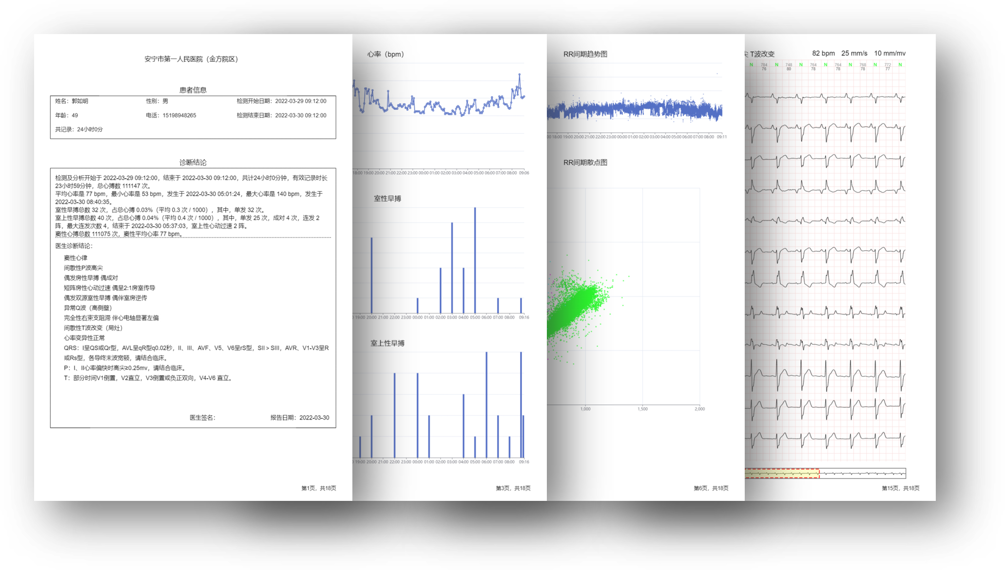 单导联长程连续心电图分析软件
